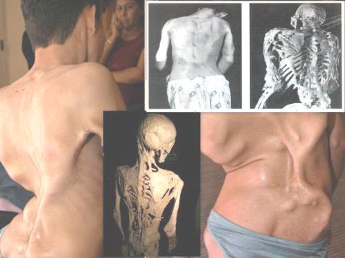 Hội chứng người hóa đá - Hình ảnh minh họa